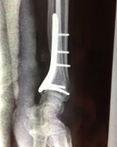 plaque vissée antérieure pour fracture du radius distal radiographie de profil michel vercoutere