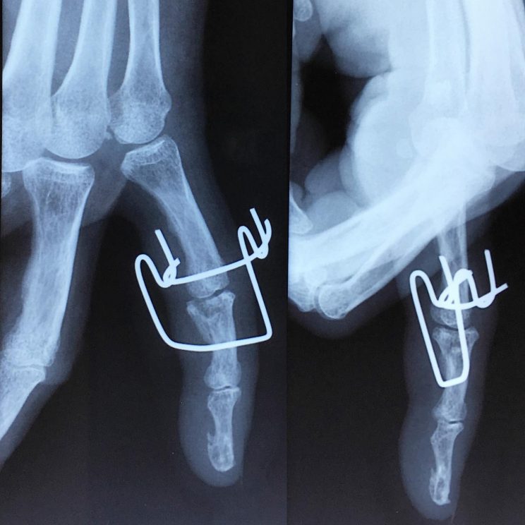 La fracture comminutive avec enfoncement de la base de la ème phalange L institut de